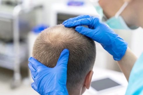En läkare undersöker en mans hårbotten inför en hårtransplantation.