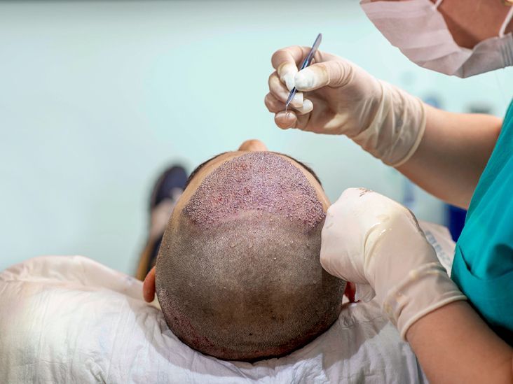 Image for hair transplant surgeon